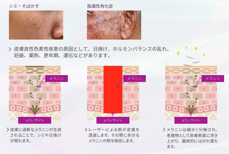 レーザーフェイシャルとは